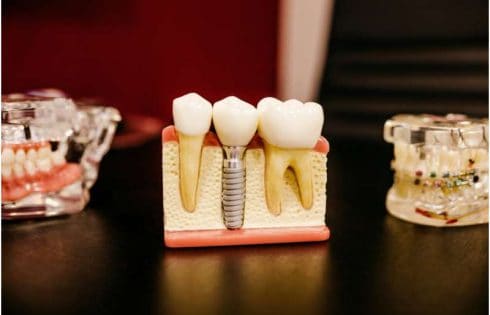 Titanium particles may explain why antibiotics fail against dental implant infections