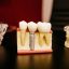Titanium particles may explain why antibiotics fail against dental implant infections