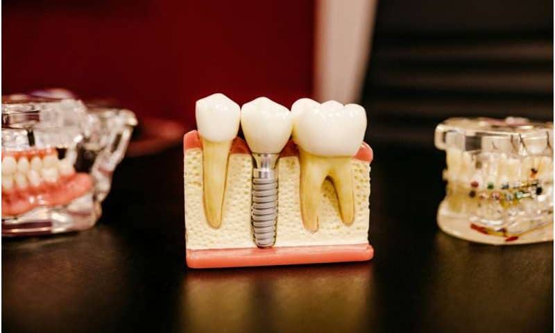Titanium particles may explain why antibiotics fail against dental implant infections
