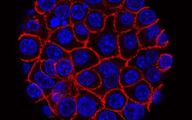 Blocking a cellular inflammation process could result in effective therapy for pancreatic cancer