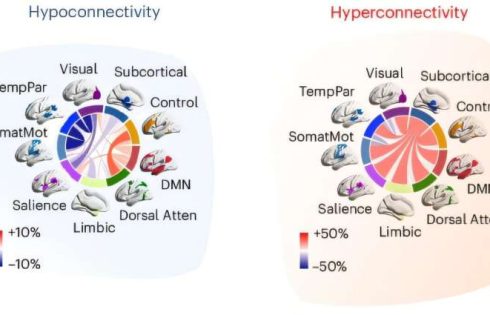 Autism may have two distinct subtypes based on brain connectivity patterns