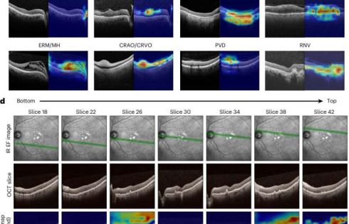 New AI tools could help eye doctors diagnose retinal disease faster